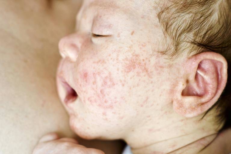 4 Babys sterben an Keuchhusten - RKI schlägt Alarm! Impfquote zu niedrig